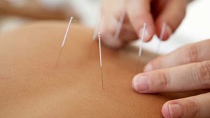 acupuncture image